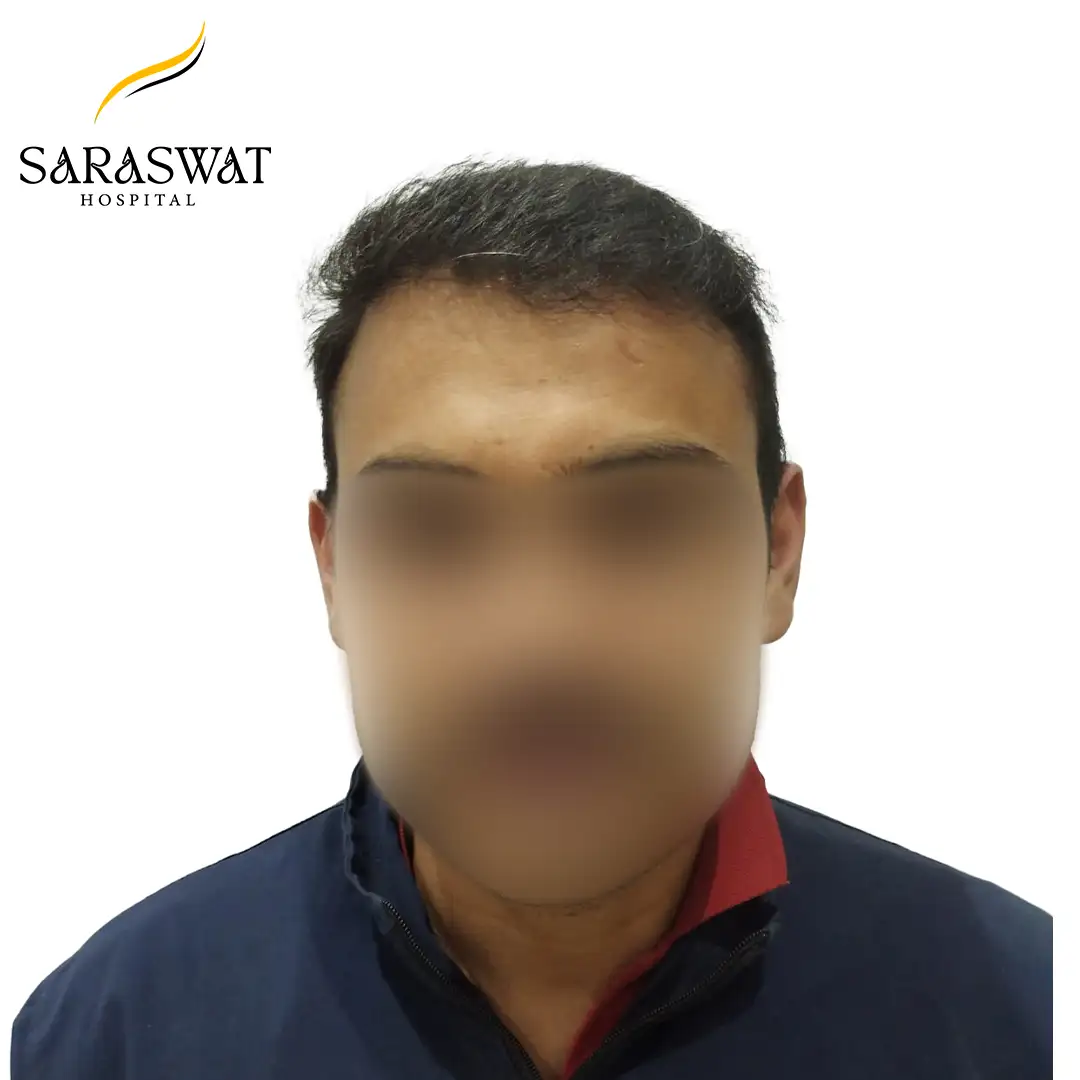 Front FUE Hair Transplant Result After Procedure