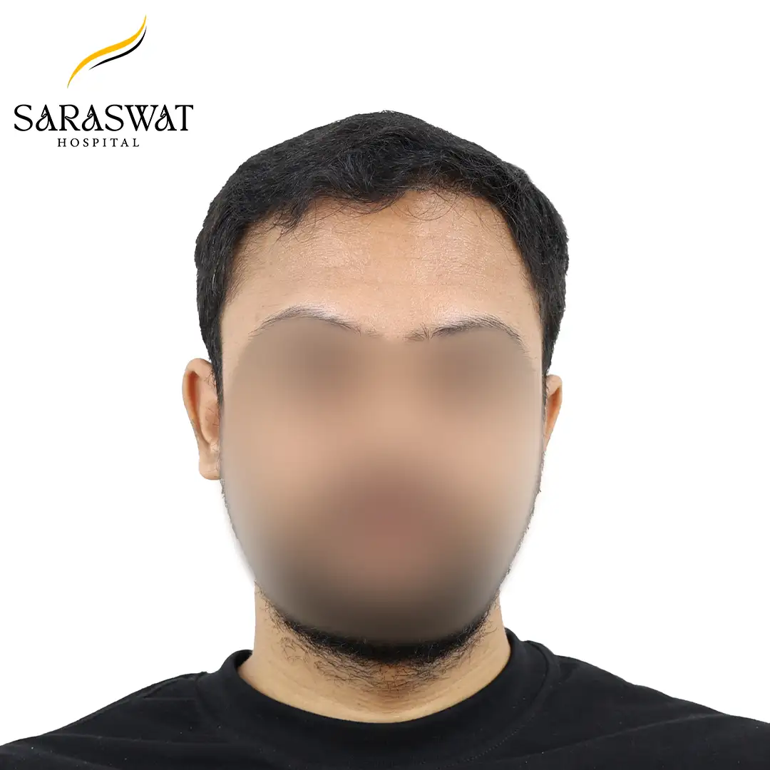 Front FUE Hair Transplant Result After Procedure