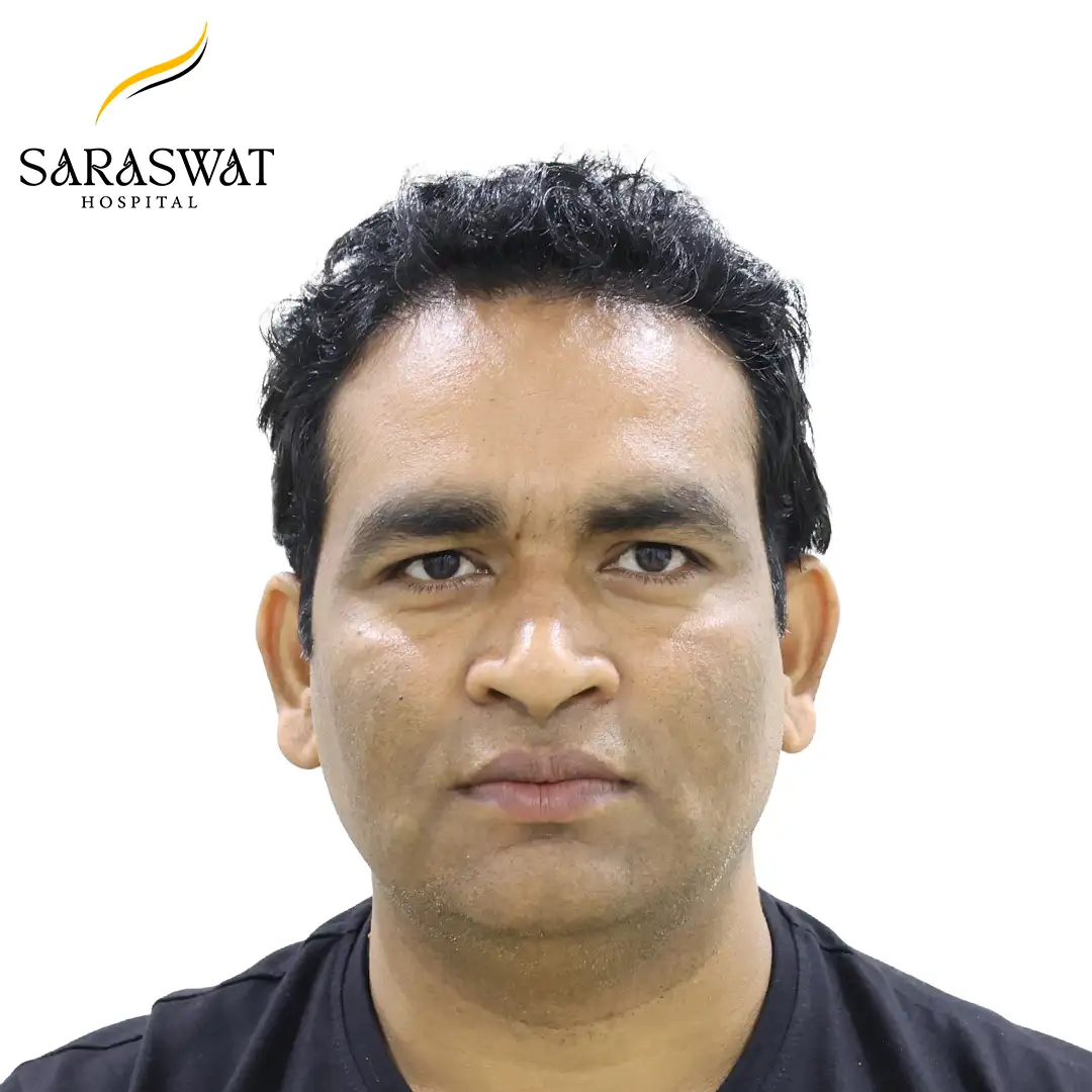 Front FUE Hair Transplant Result After Procedure