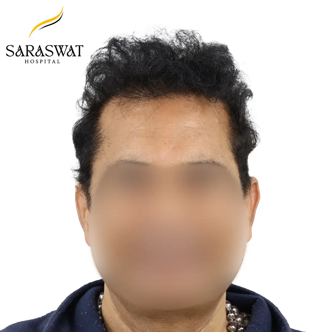 FUE Hair Transplant Result