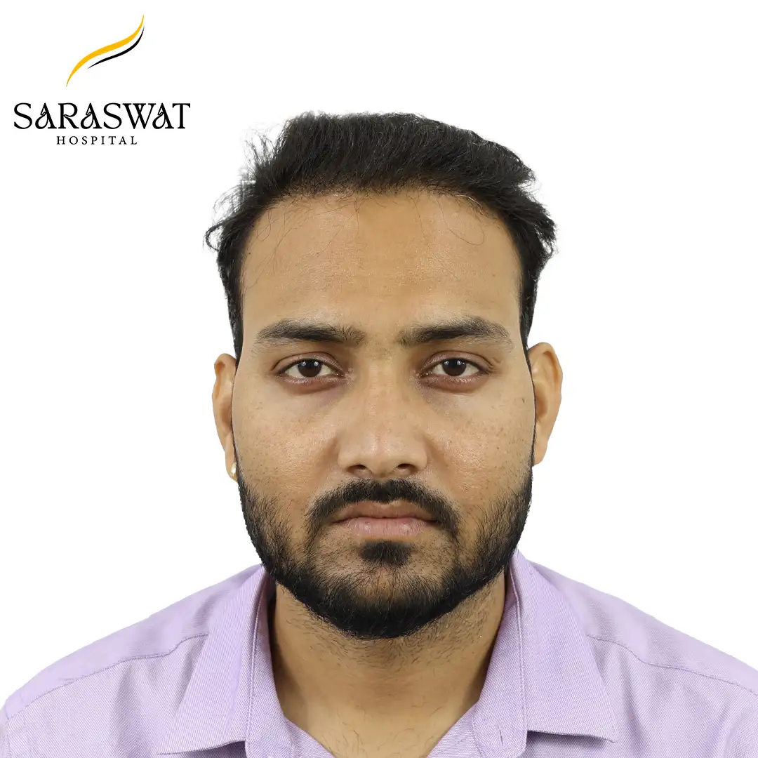 Front FUE Hair Transplant Result After Procedure