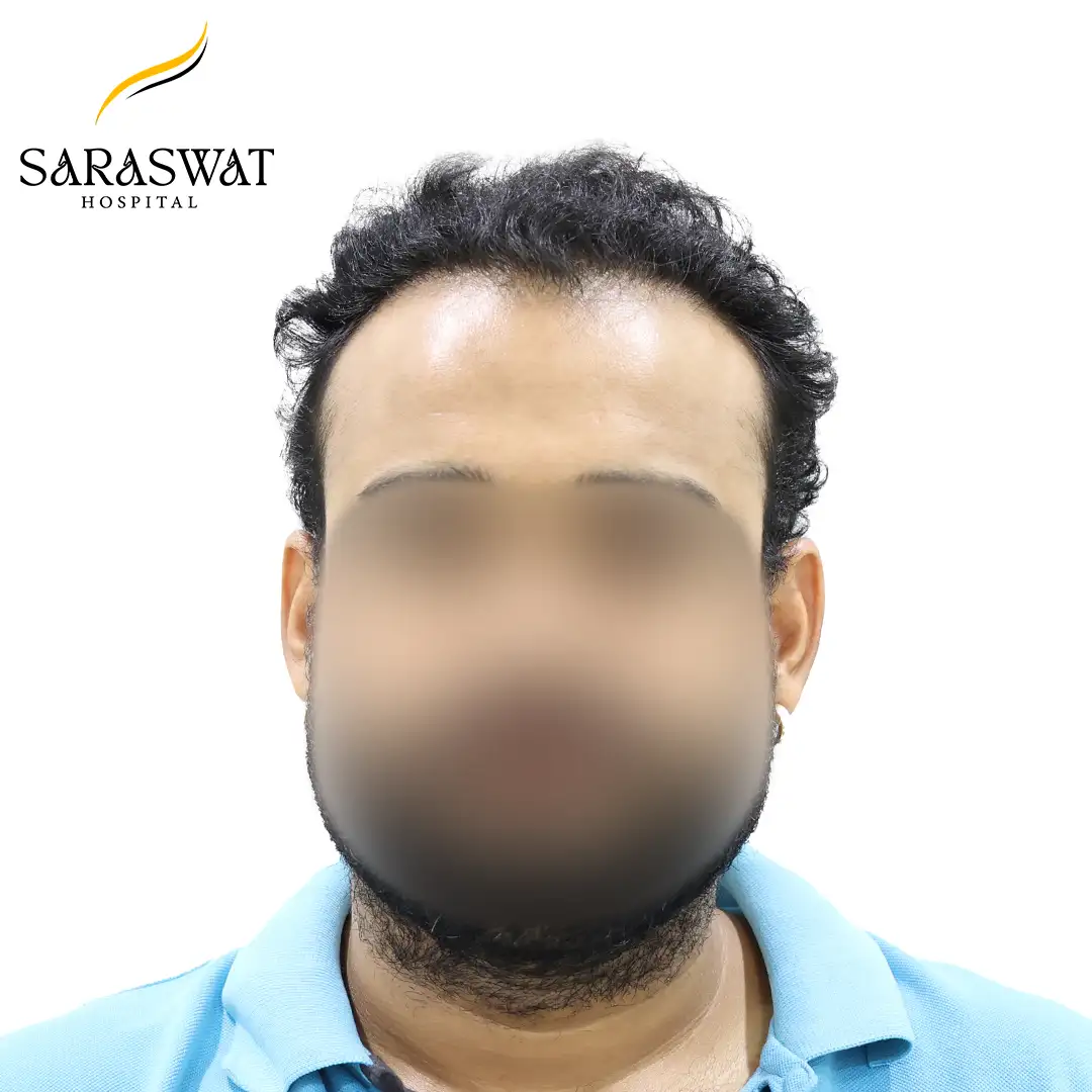FUE Hair Transplant