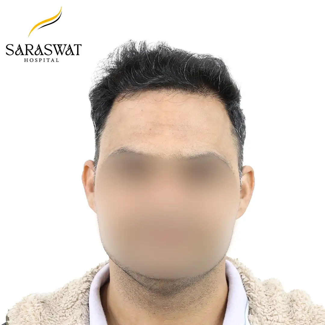 Front FUE Hair Transplant Result After Procedure