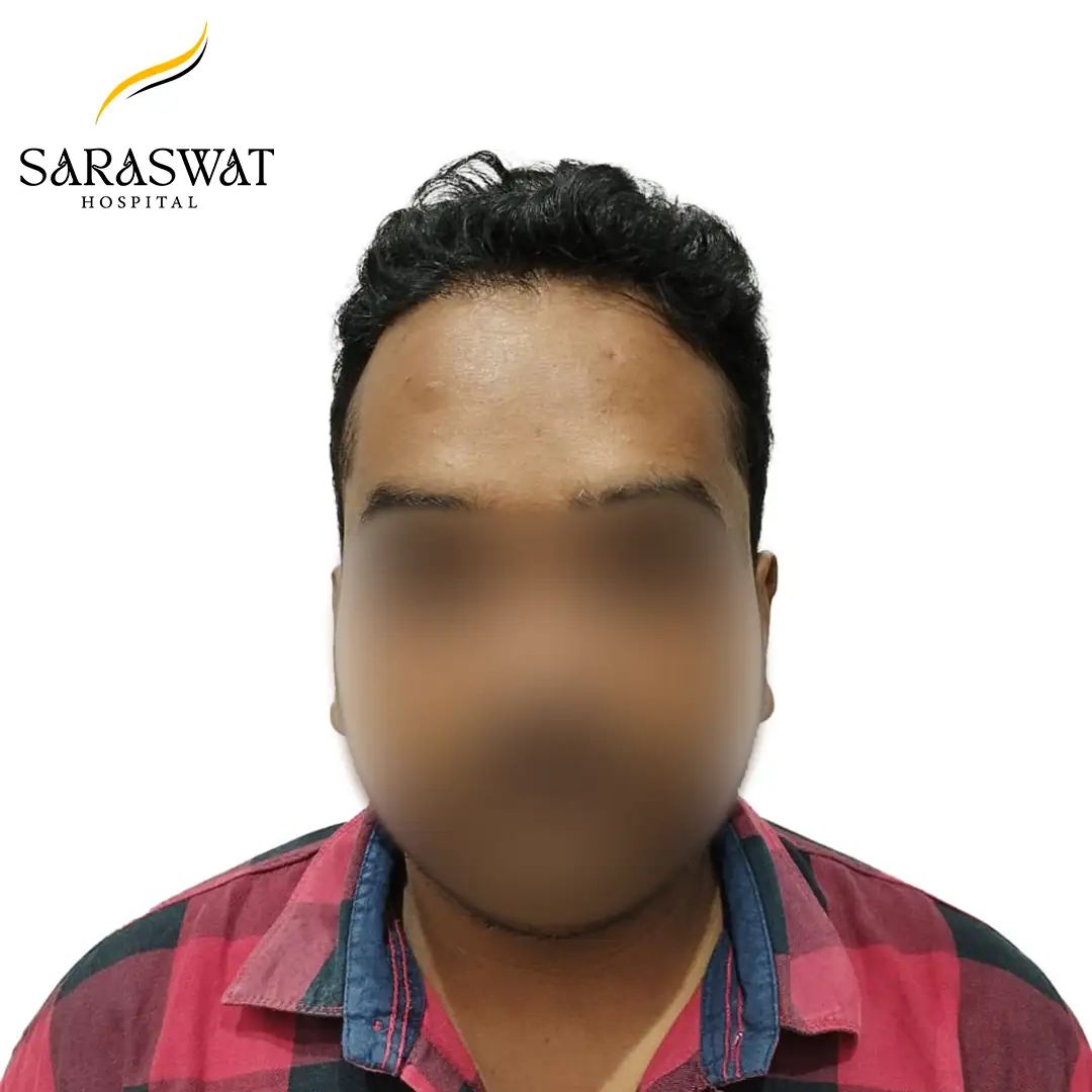 Front FUE Hair Transplant Result After Procedure
