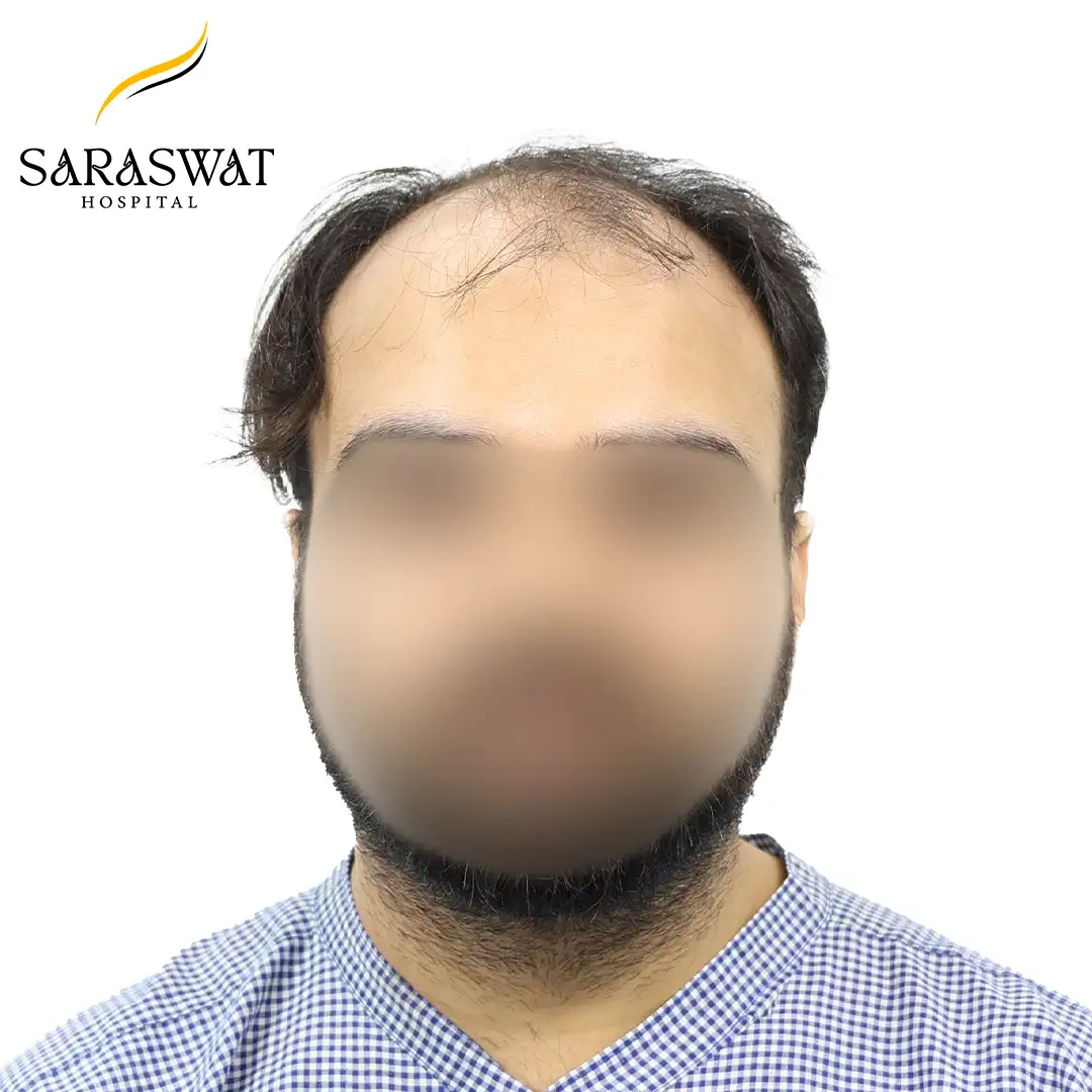 Front FUE Hair Transplant Result Before Procedure