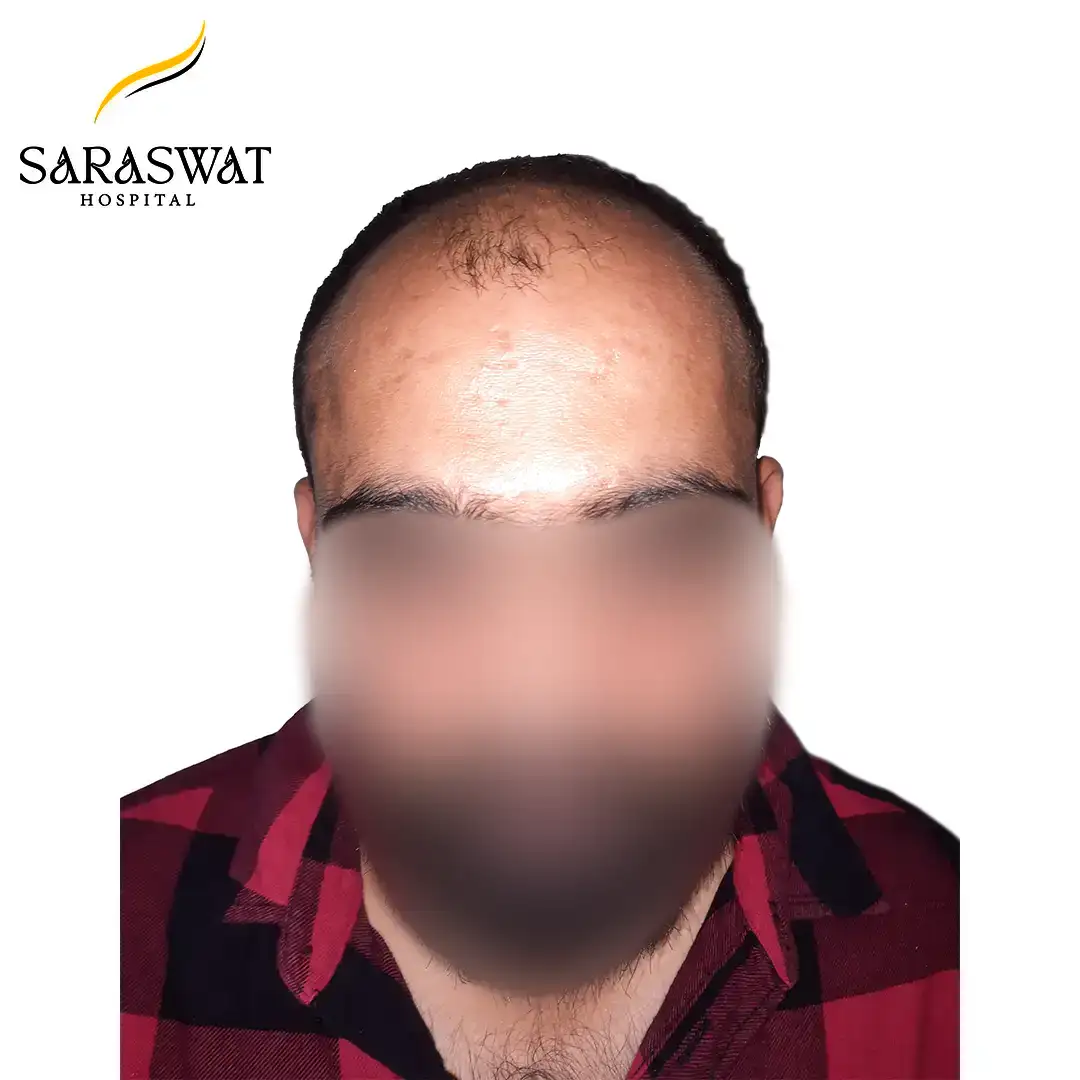 Hair Transplant Before and After Result