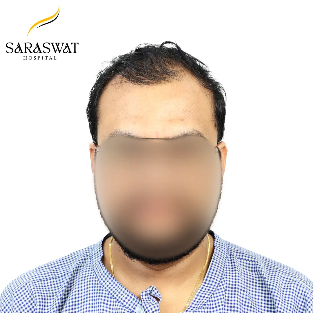 Front FUE Hair Transplant Result Before Procedure