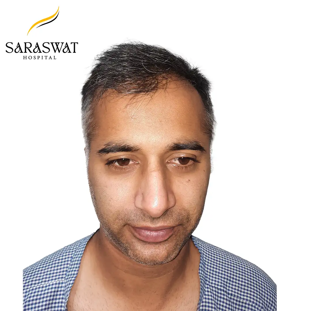 Front FUE Hair Transplant Result Before Procedure