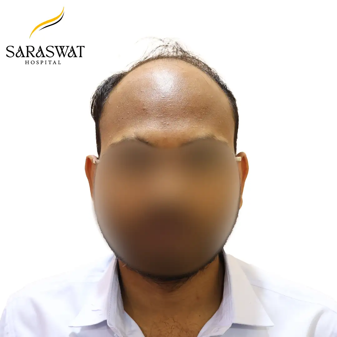 Hair Transplant Before and After Results