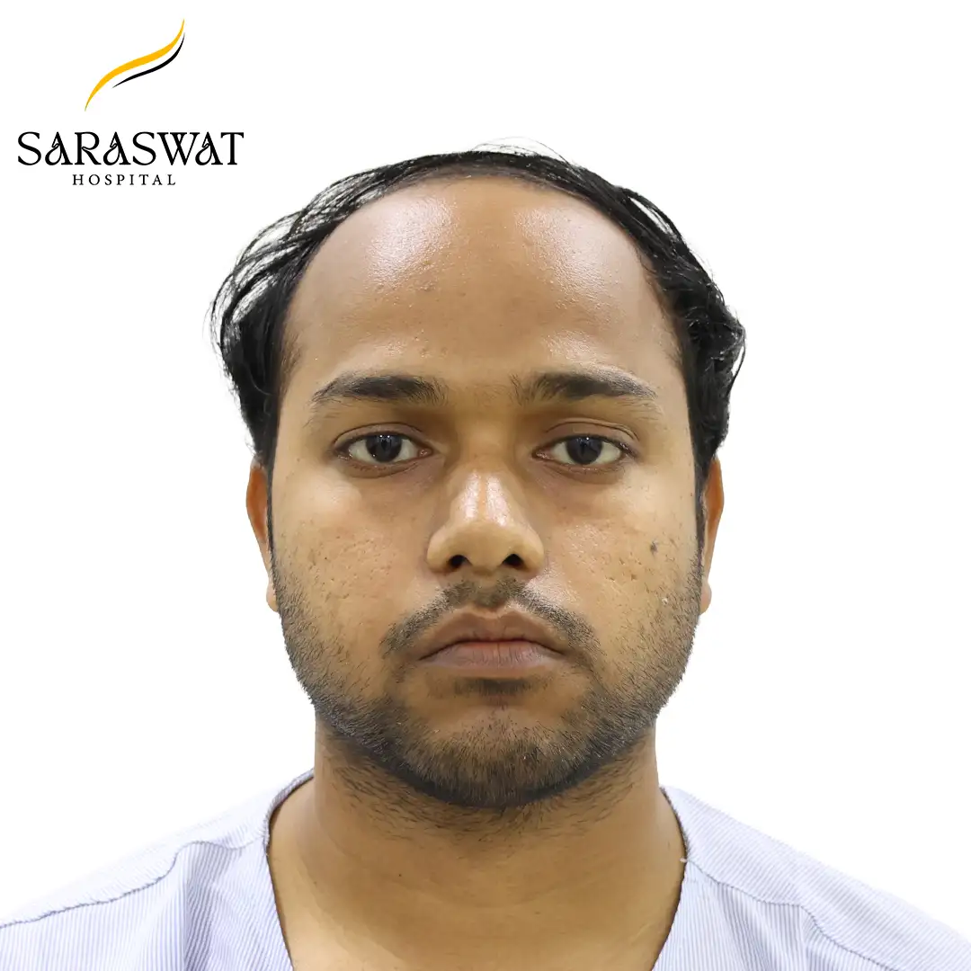Front FUE Hair Transplant Result Before Procedure