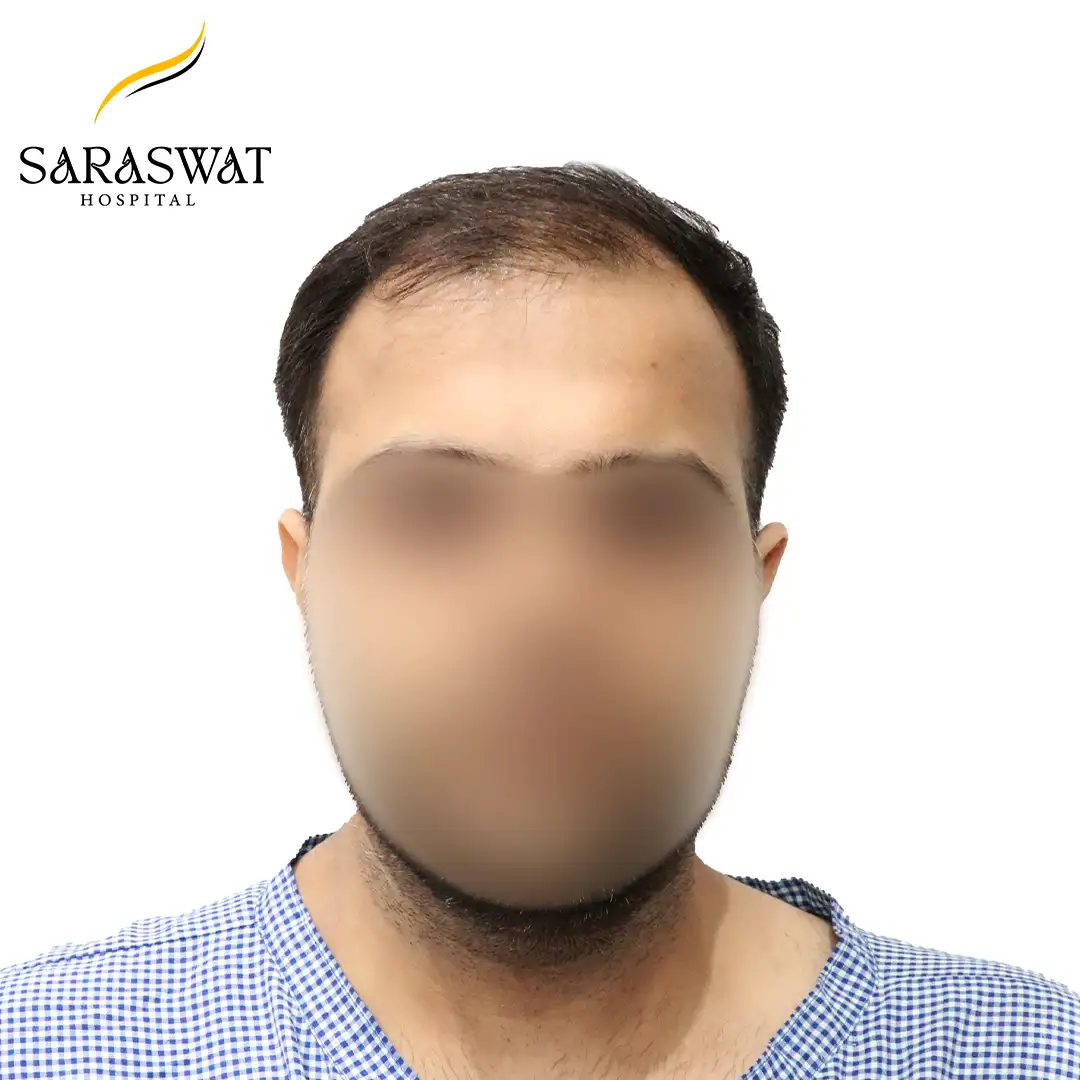 Hair Transplant Before and After