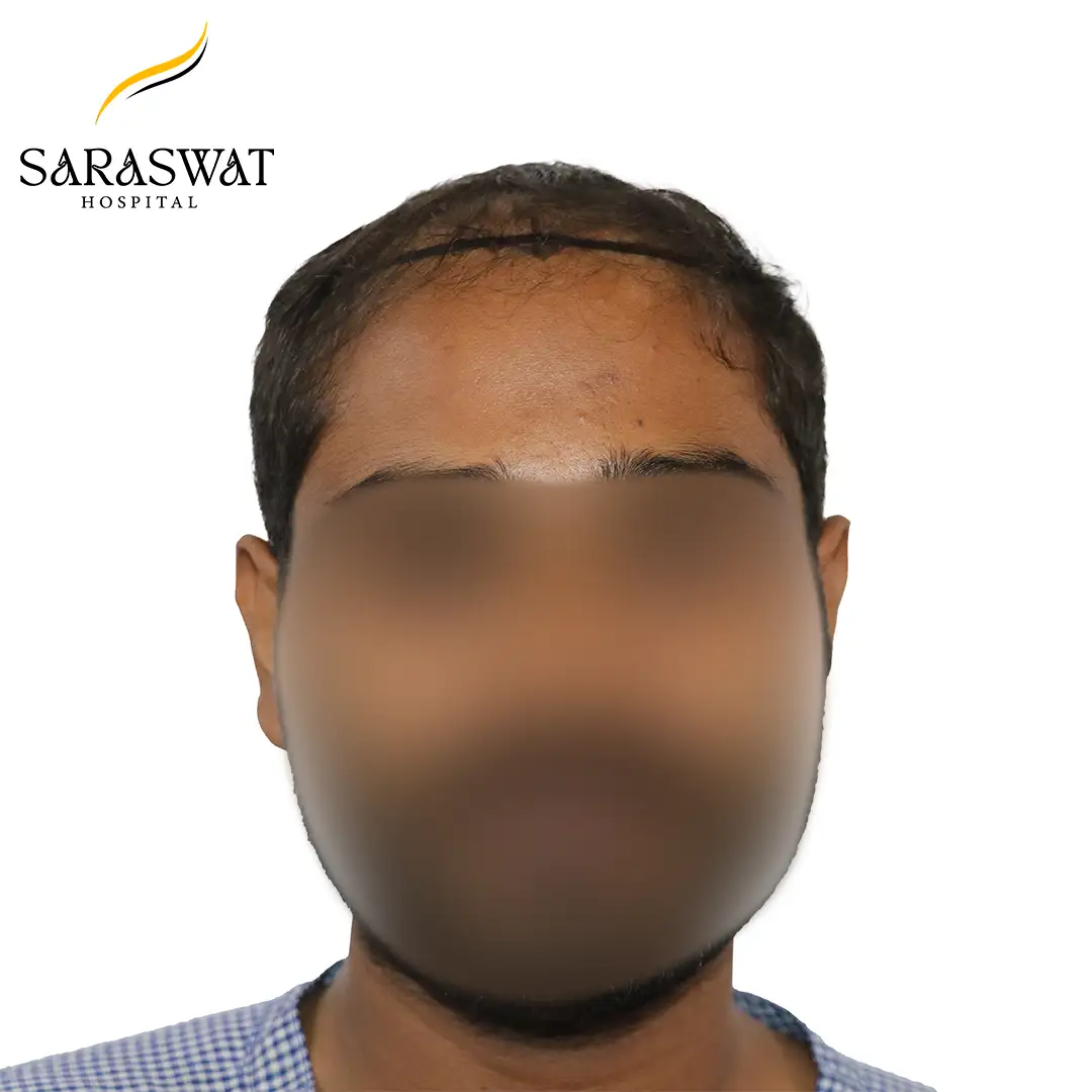 Front FUE Hair Transplant Result Before Procedure