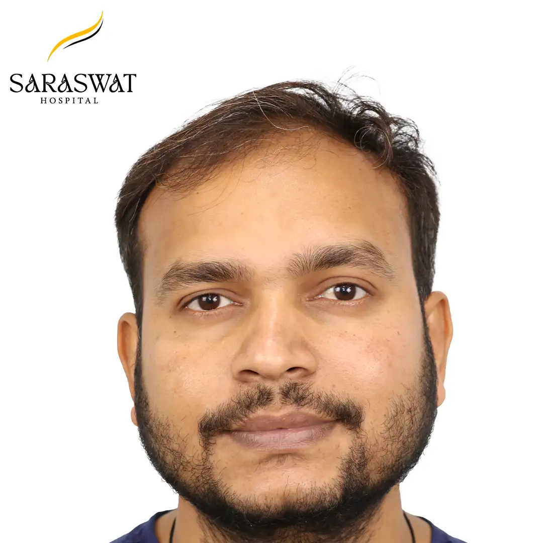 Front FUE Hair Transplant Result Before Procedure