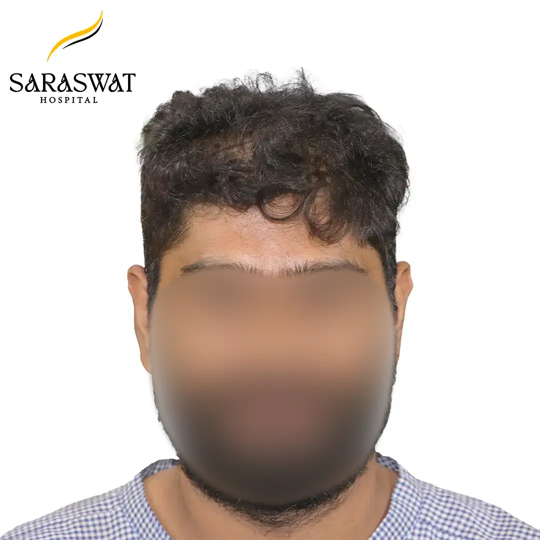 Front FUE Hair Transplant Result Before Procedure