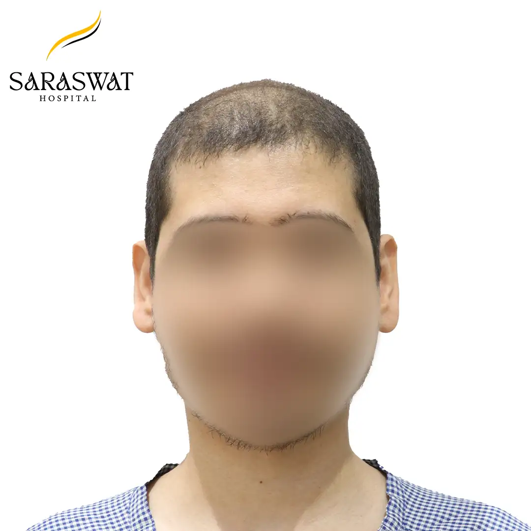 Front FUE Hair Transplant Result Before Procedure