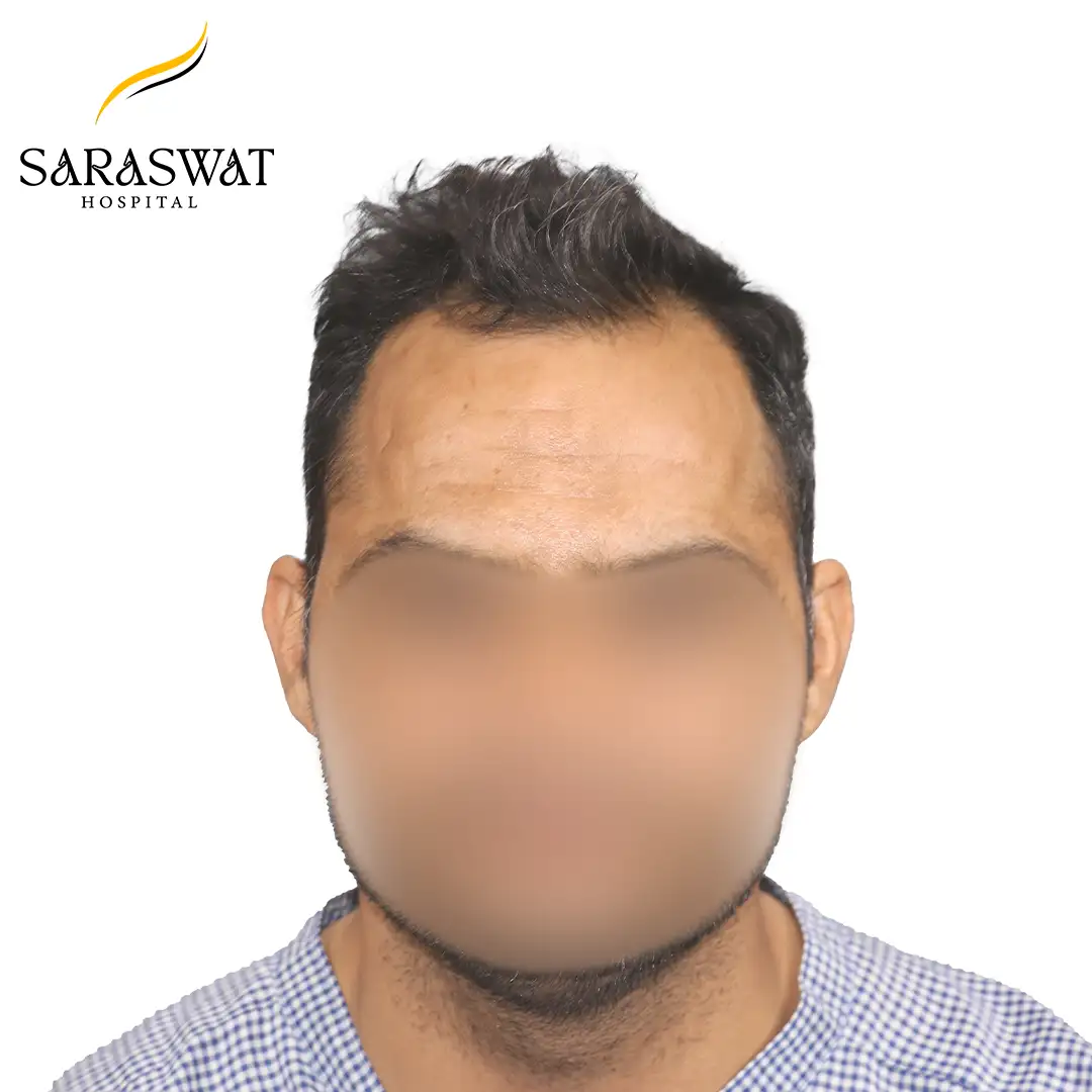 Front FUE Hair Transplant Result Before Procedure