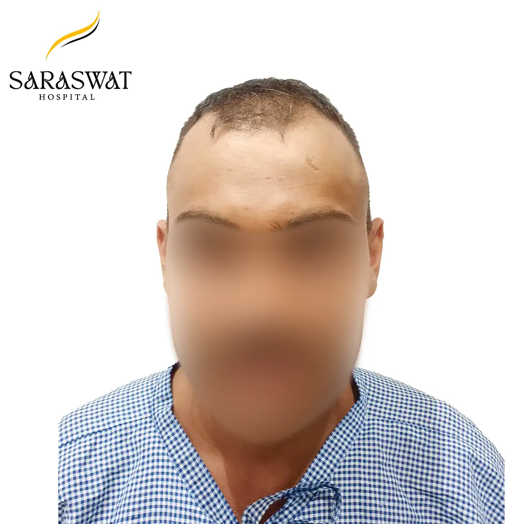 Front FUE Hair Transplant Result Before Procedure