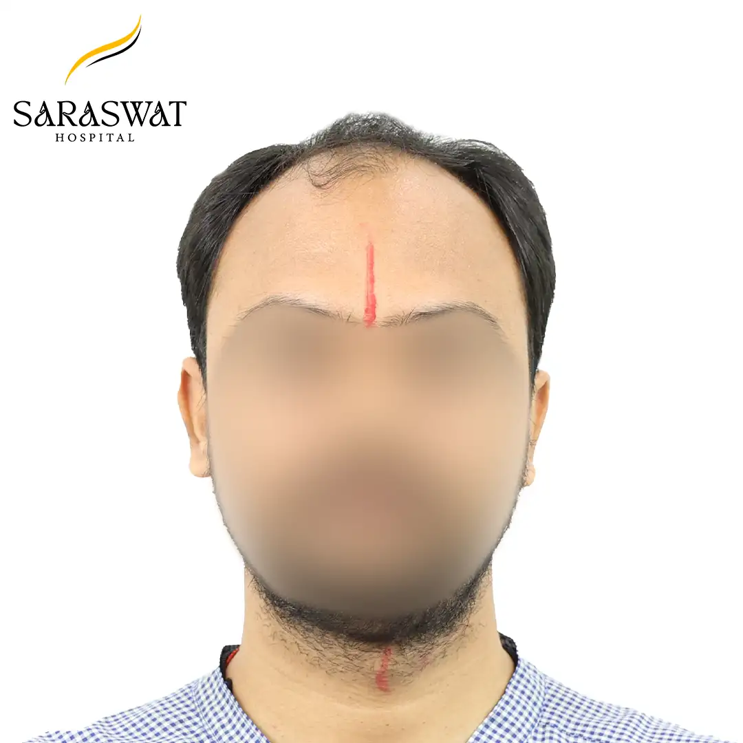 Front FUE Hair Transplant Result Before Procedure