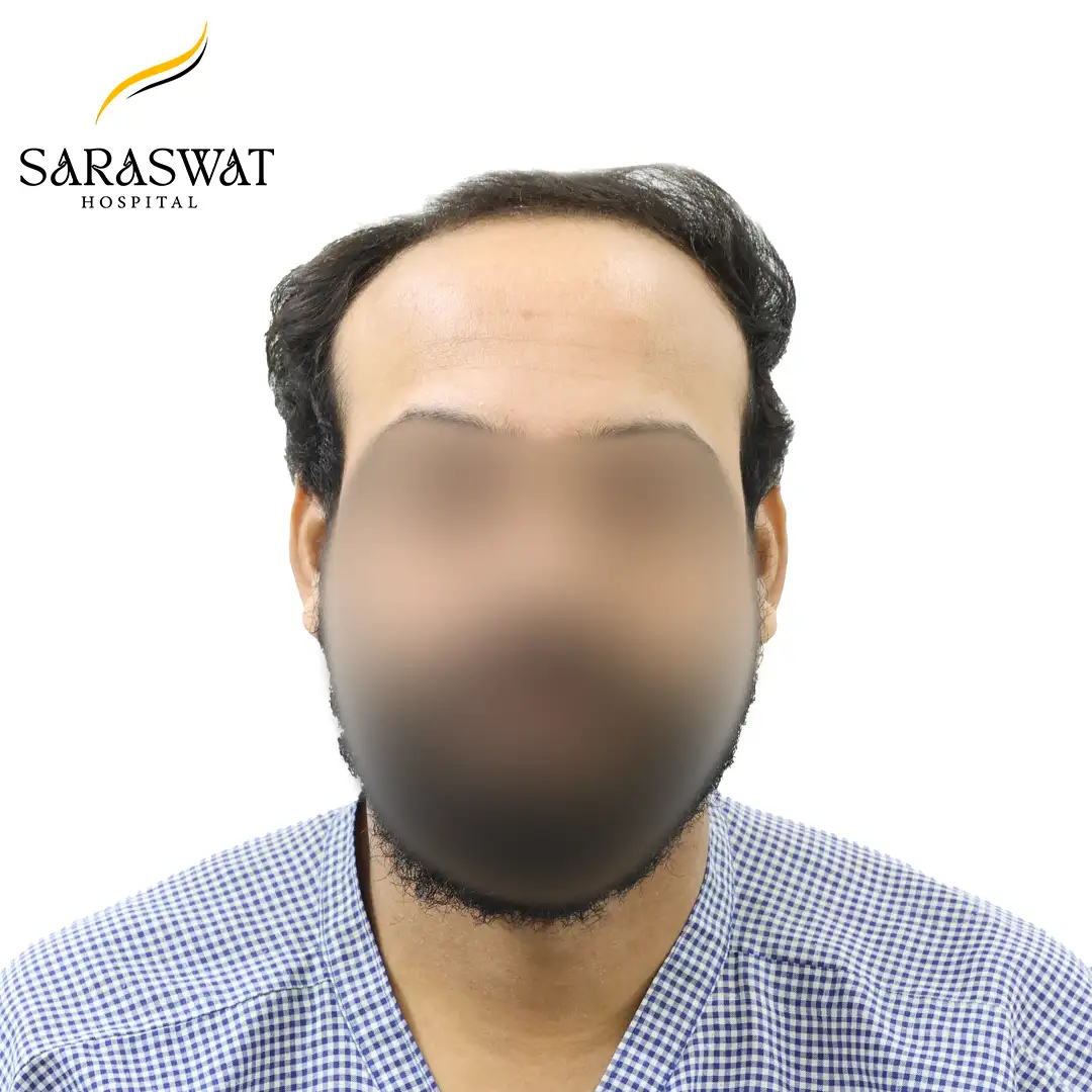 Front FUE Hair Transplant Result Before Procedure