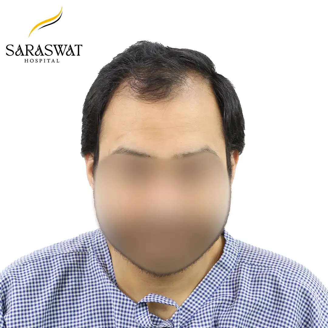 Hair Transplant Before and After Results