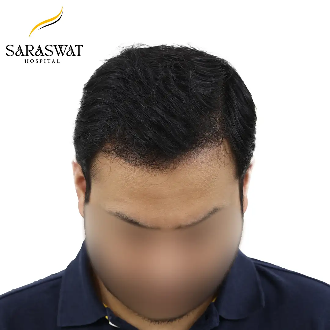 Hair Transplant Before and After Results