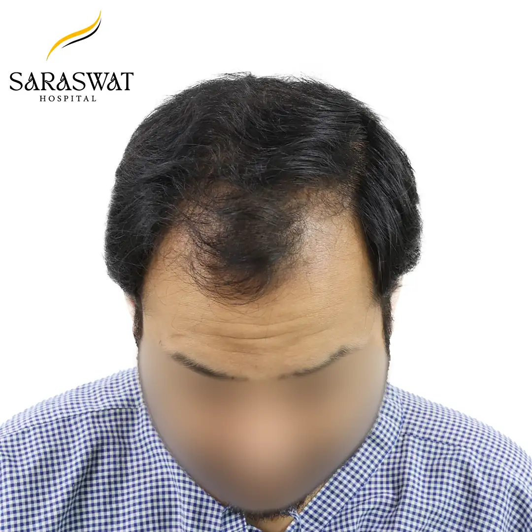Hair Transplant Before and After Results