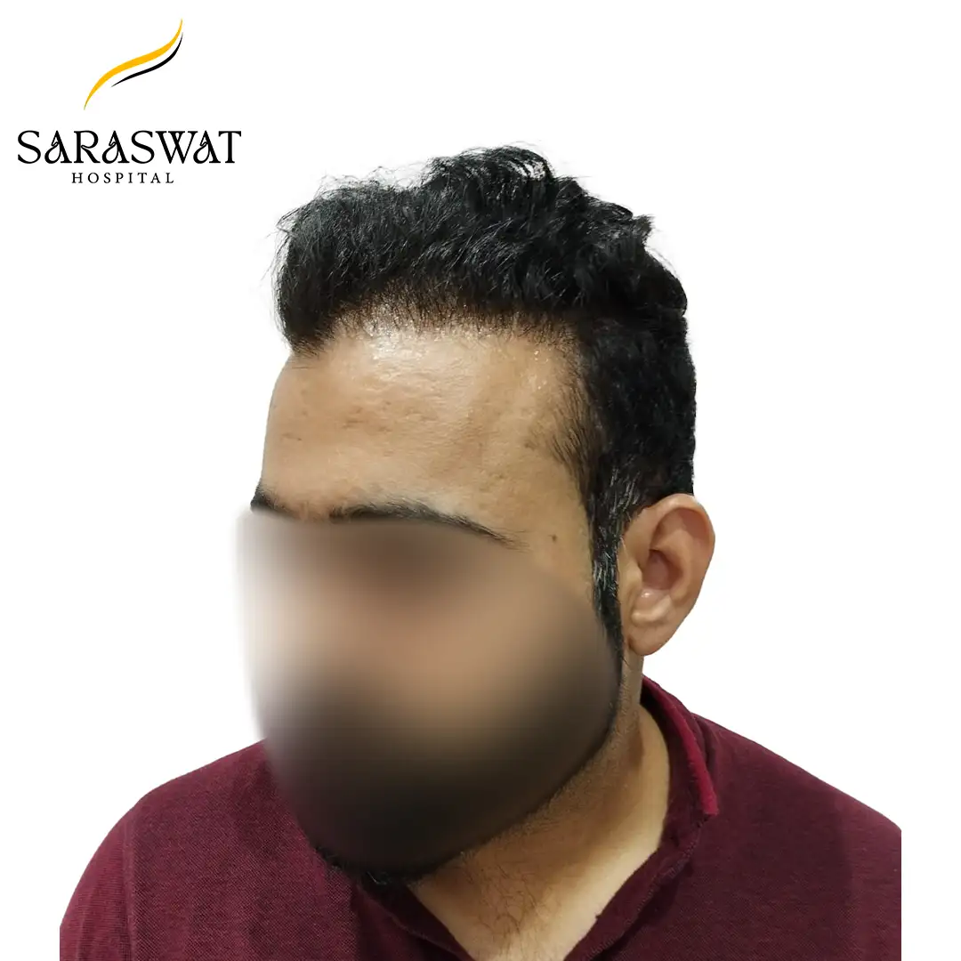 Hair Transplant Before and After Result