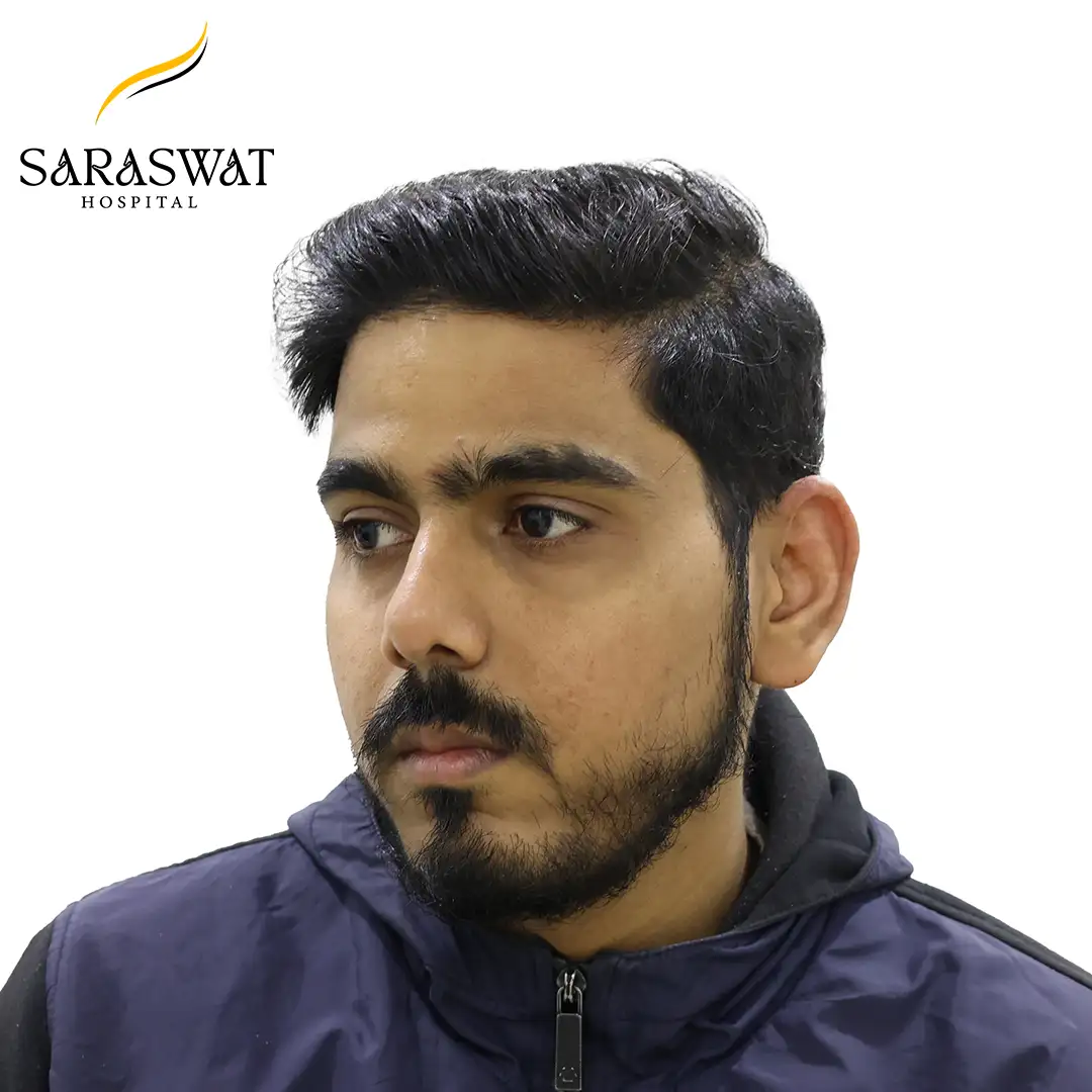 45 Degree Left FUE Hair Transplant Result After Procedure