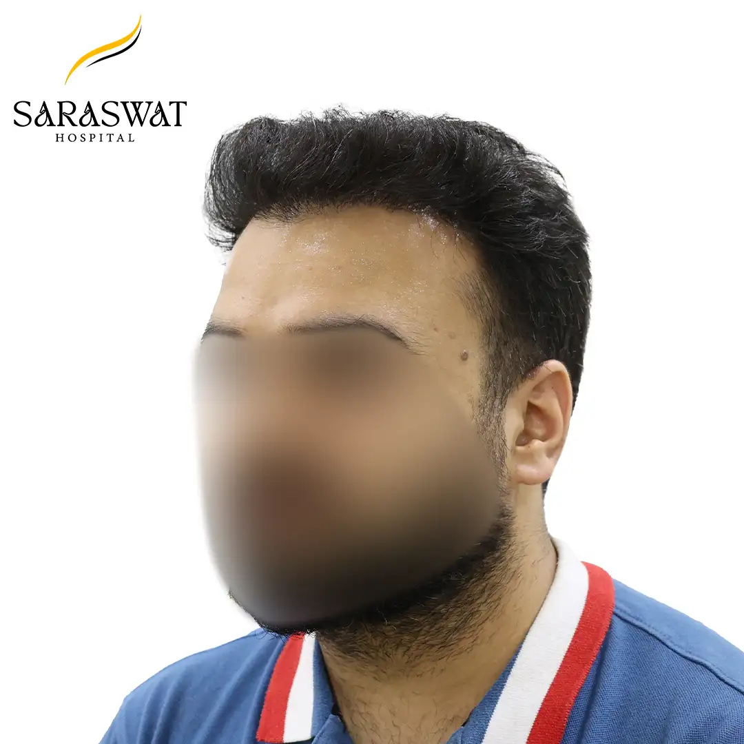 45 Degree Left FUE Hair Transplant Result After Procedure