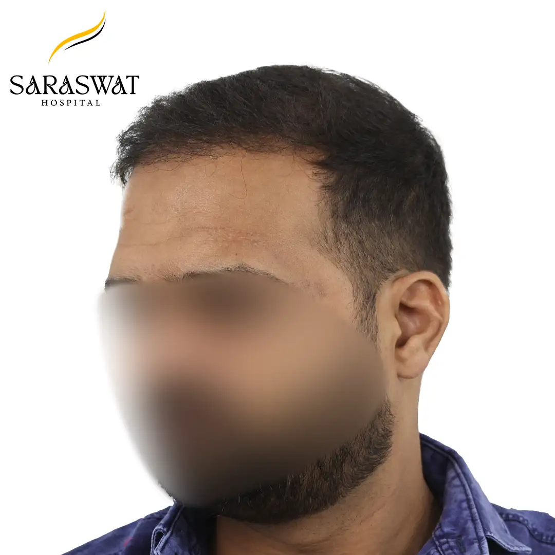 45 Degree Left FUE Hair Transplant Result After Procedure