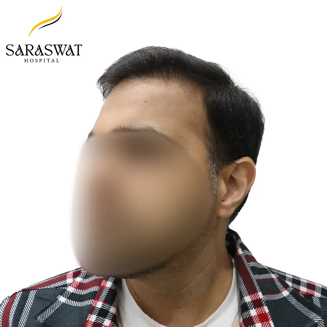 45 Degree Left FUE Hair Transplant Result After Procedure