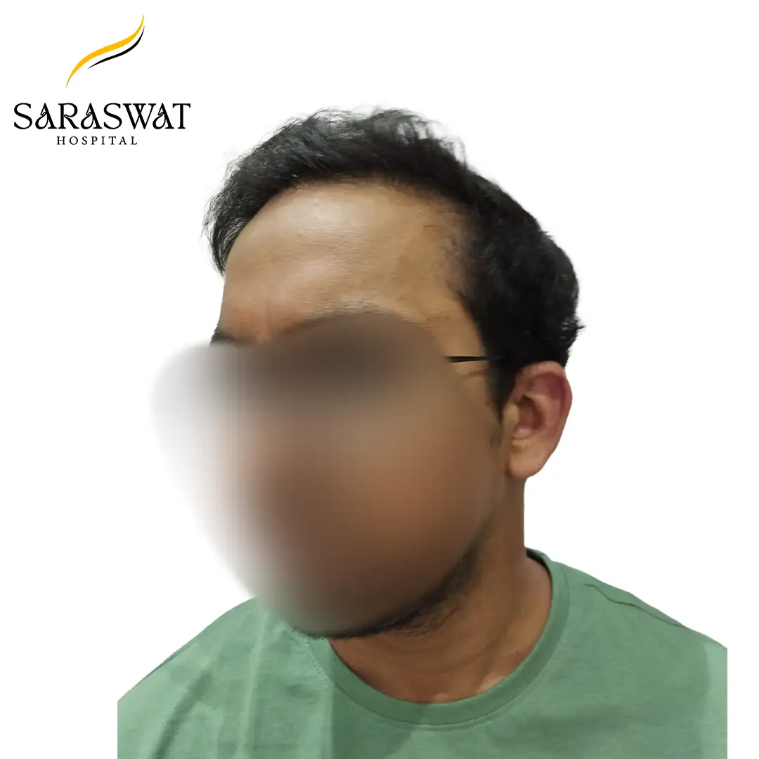 45 Degree Left FUE Hair Transplant Result After Procedure