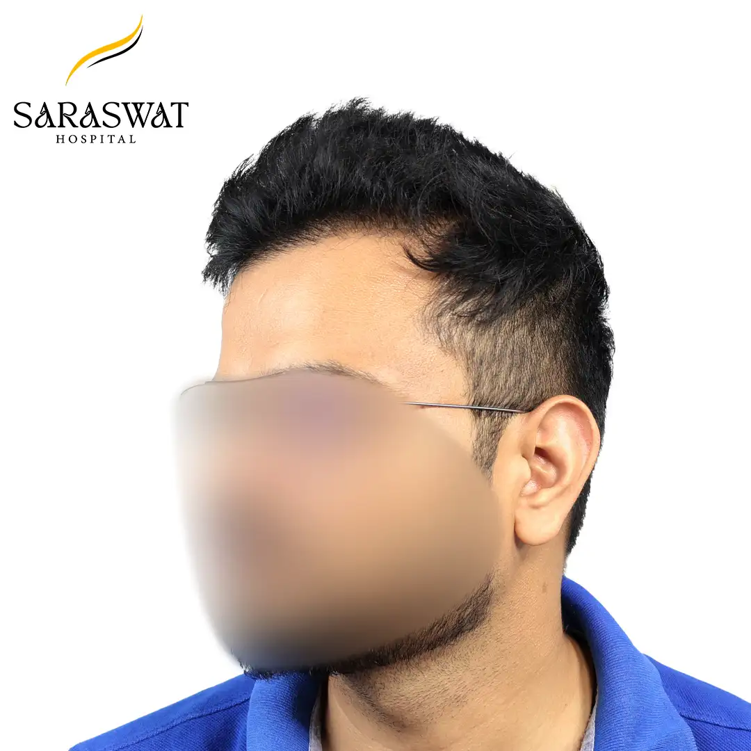 Hair Transplant Before and After Results