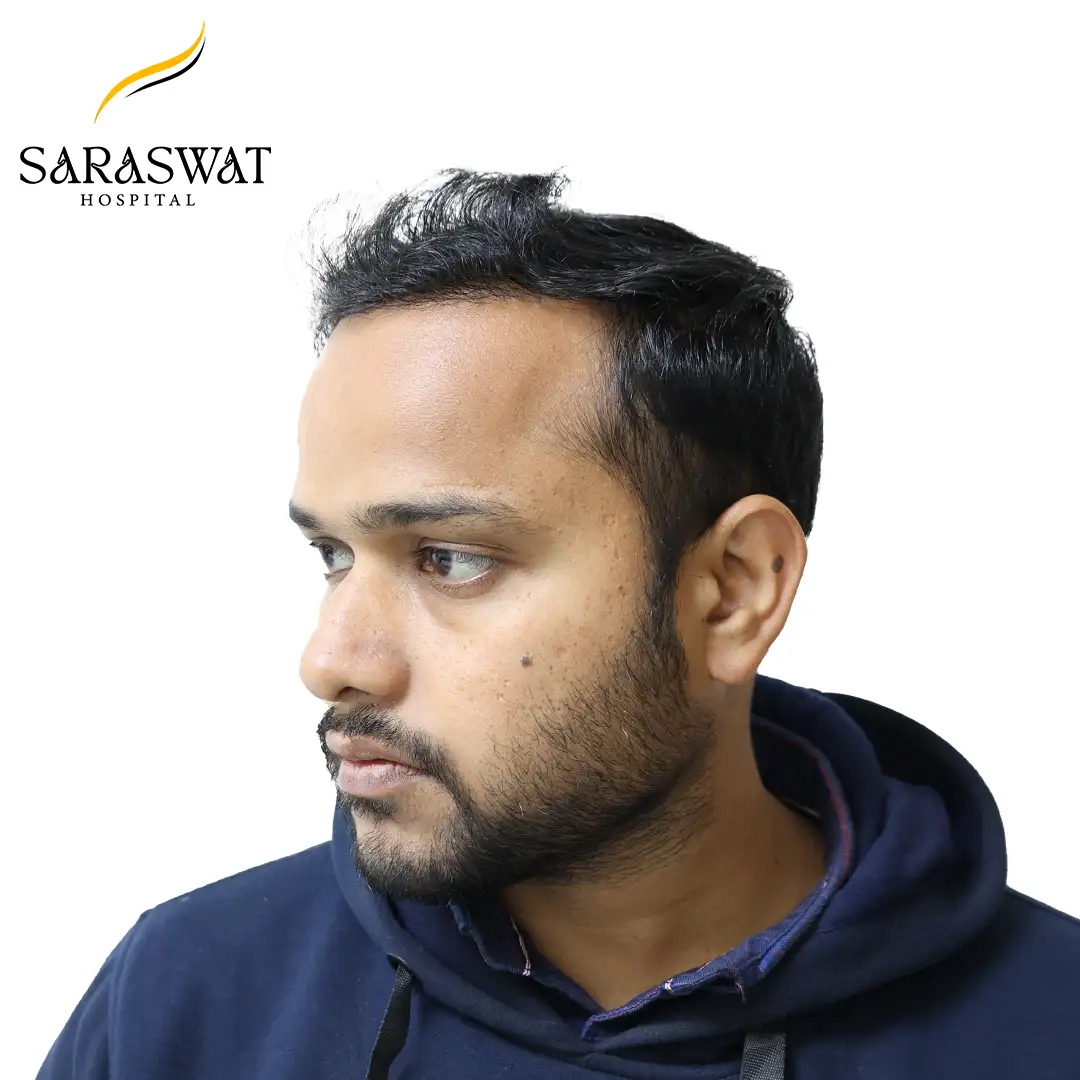 45 Degree Left FUE Hair Transplant Result After Procedure