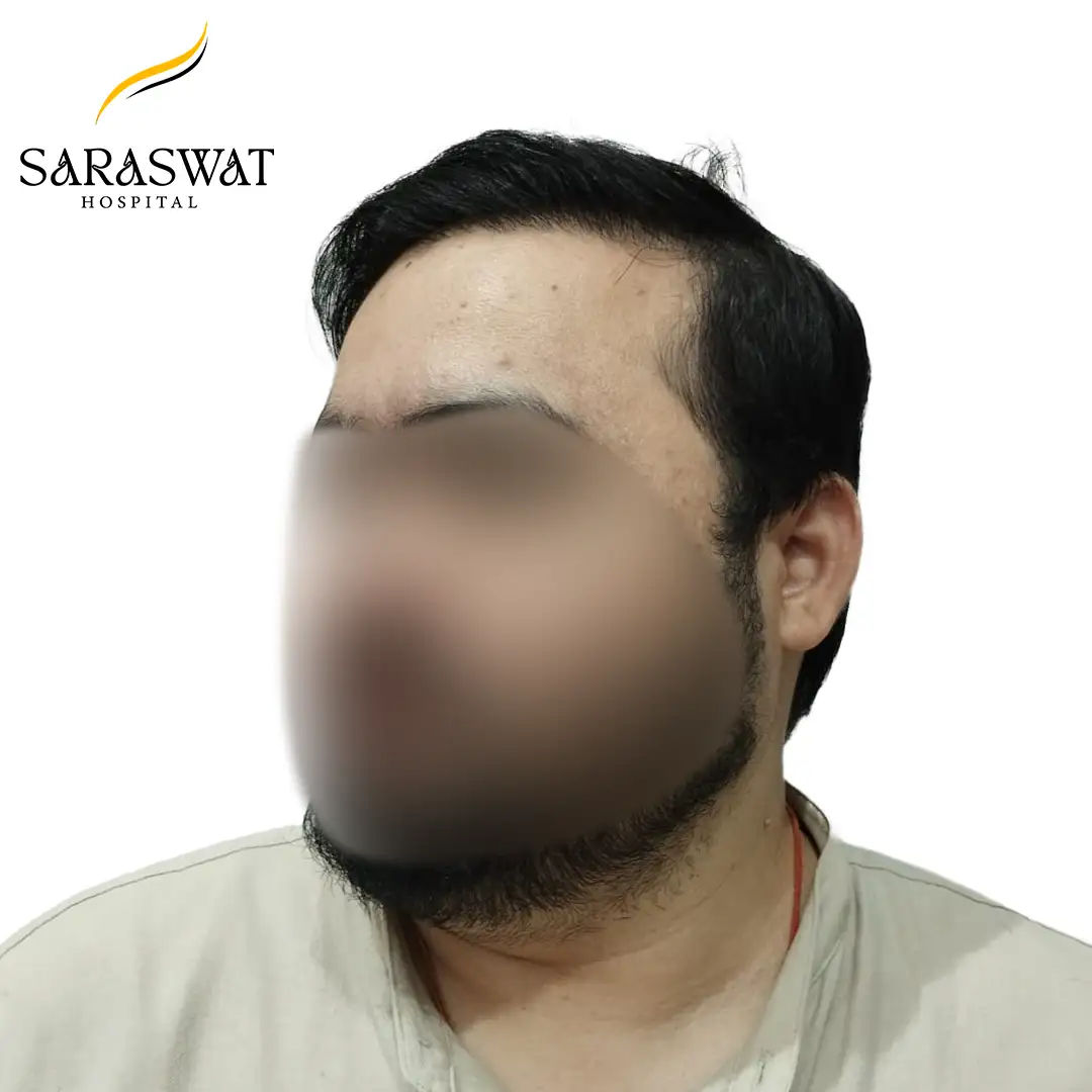 45 Degree Left FUE Hair Transplant Result After Procedure