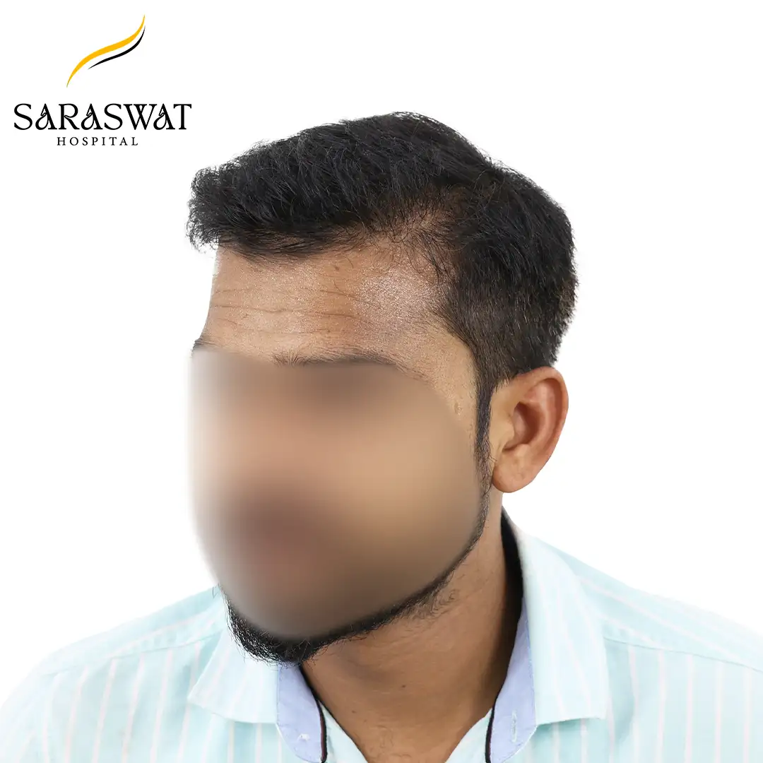 45 Degree Left FUE Hair Transplant Result After Procedure