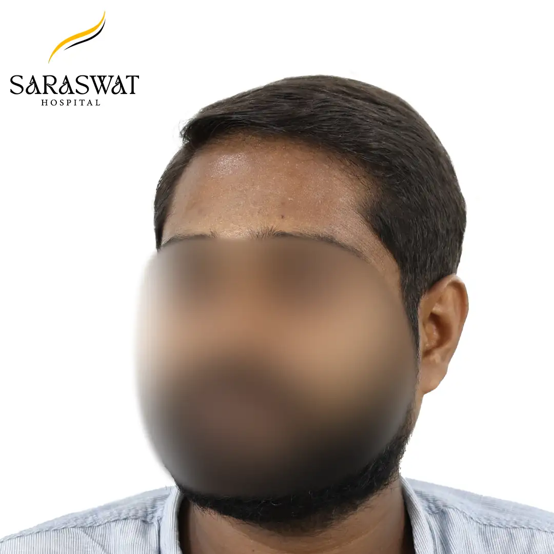 45 Degree Left FUE Hair Transplant Result After Procedure