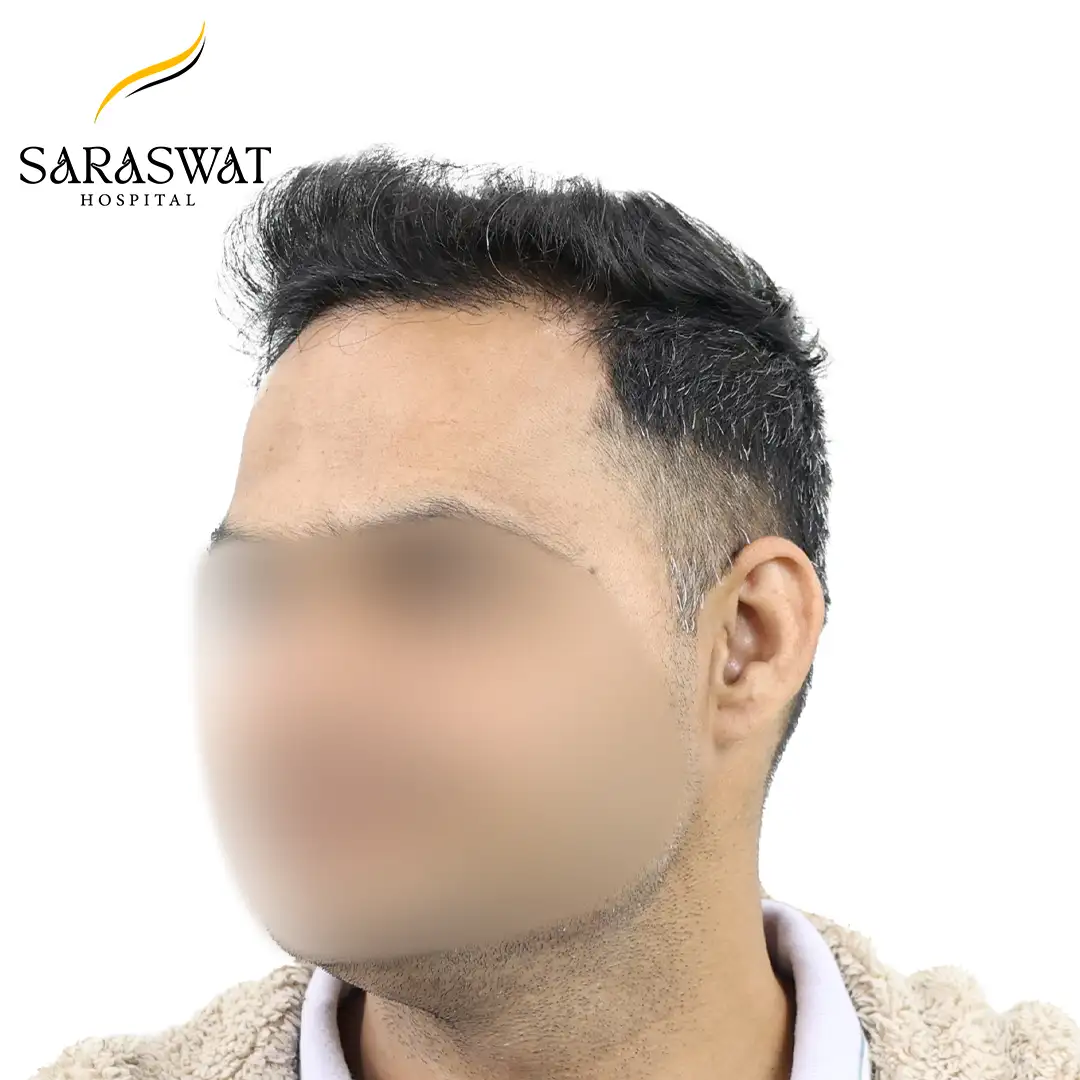 45 Degree Left FUE Hair Transplant Result After Procedure
