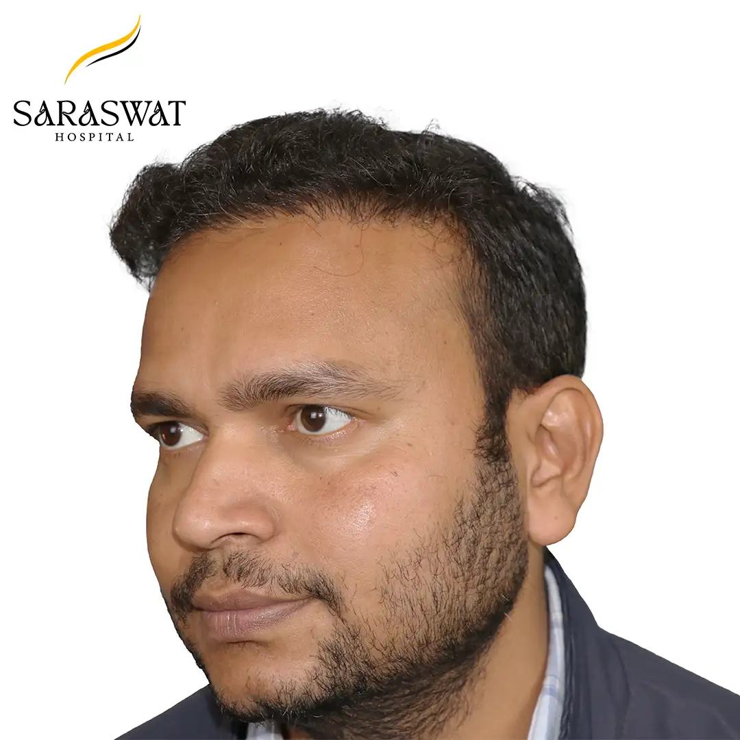 45 Degree Left FUE Hair Transplant Result After Procedure