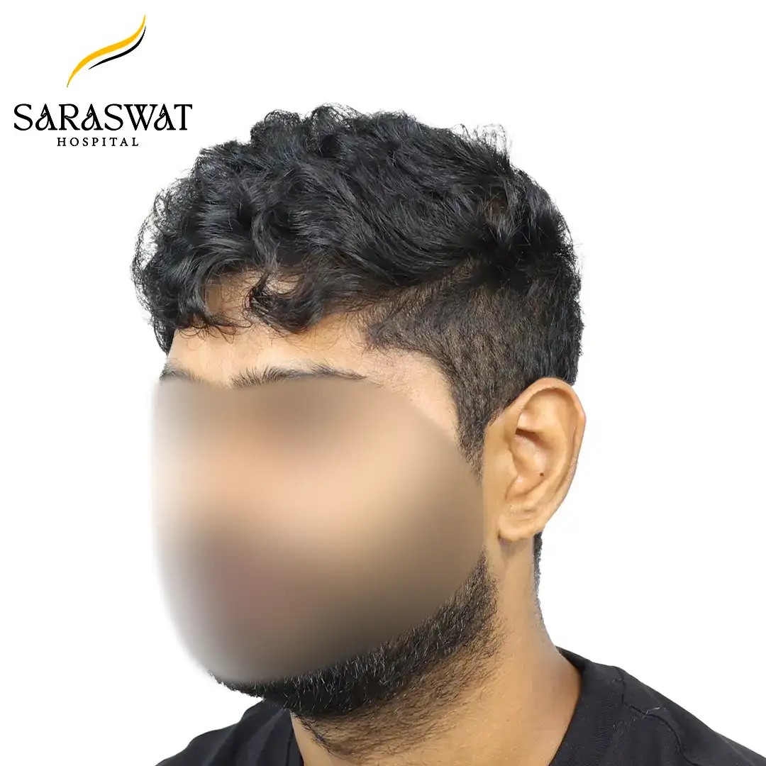 45 Degree FUE Hair Transplant Result After Procedure