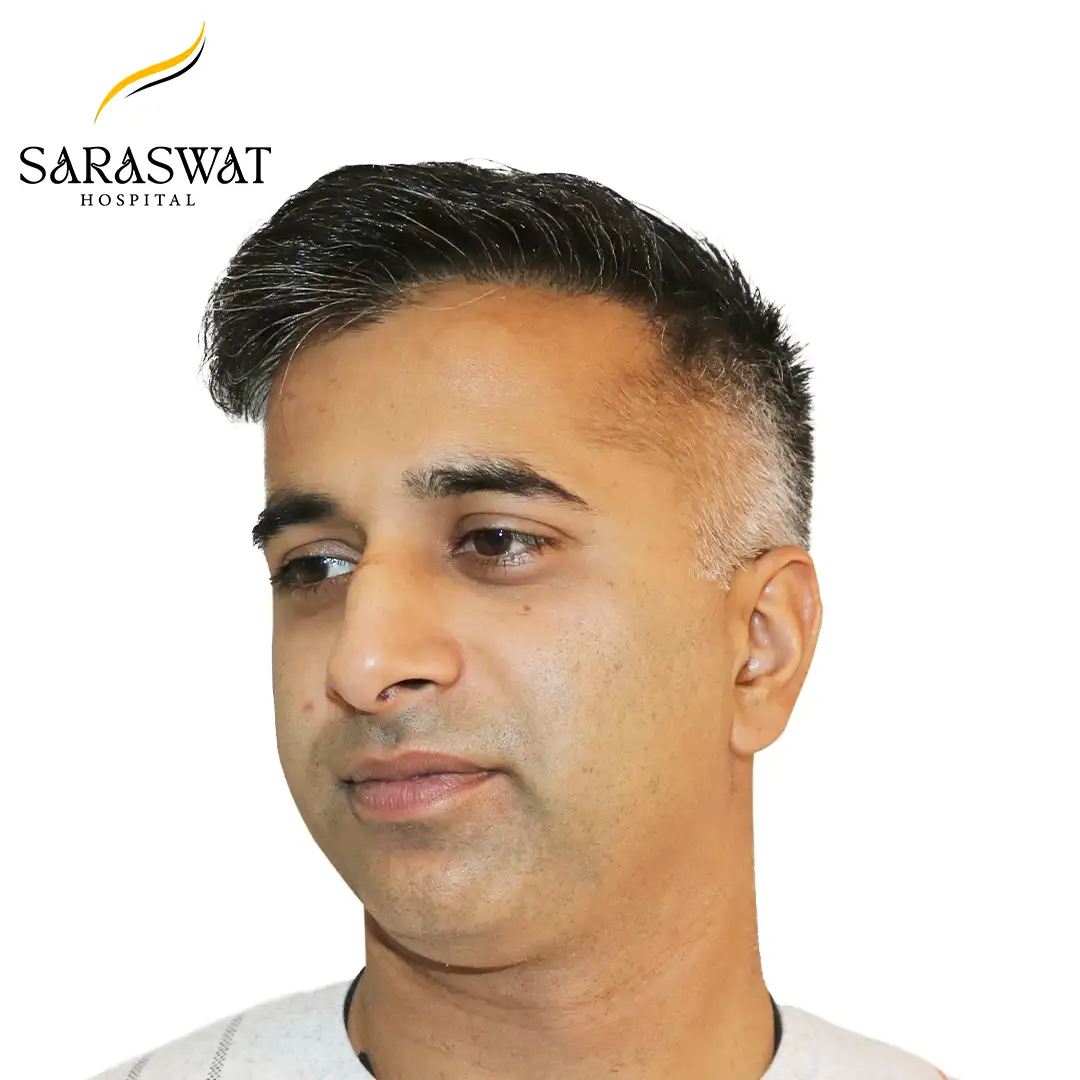 45 Degree Left FUE Hair Transplant Result After Procedure