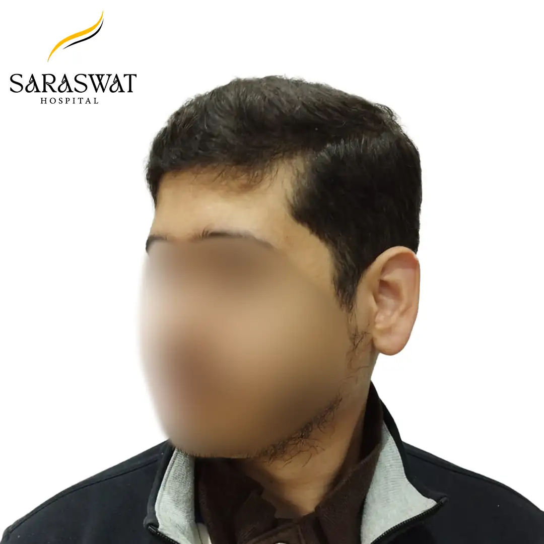 Hair Transplant Cost