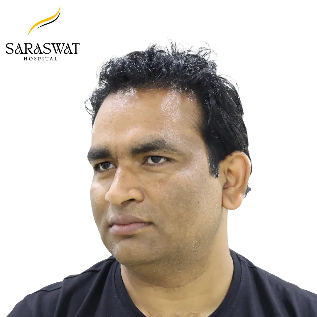 45 Degree Left FUE Hair Transplant Result After Procedure