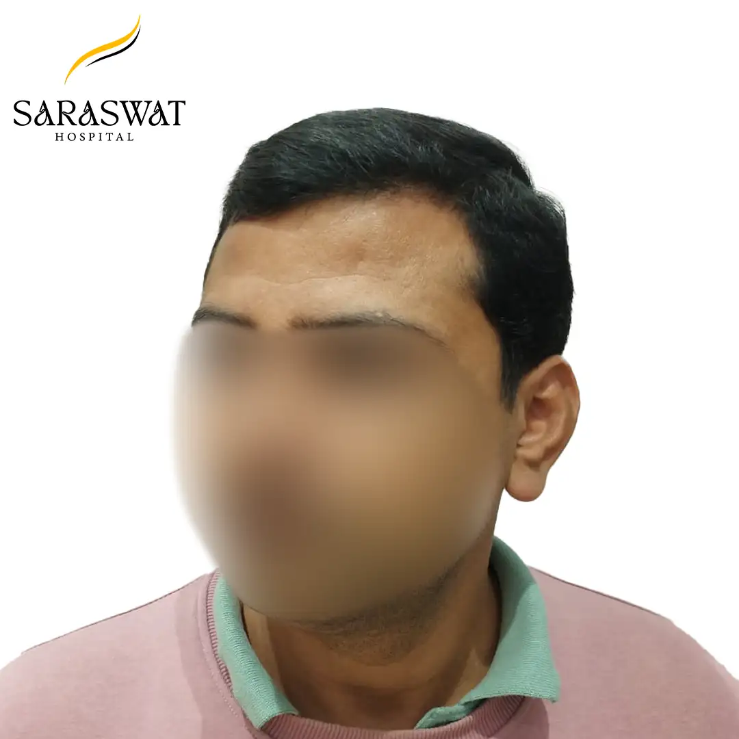 45 Degree Right FUE Hair Transplant Result After Procedure