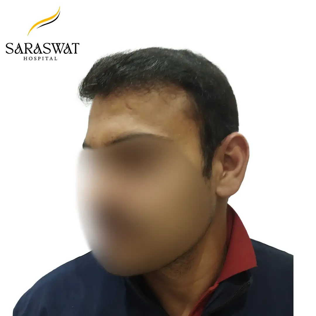 45 Degree Left FUE Hair Transplant Result After Procedure