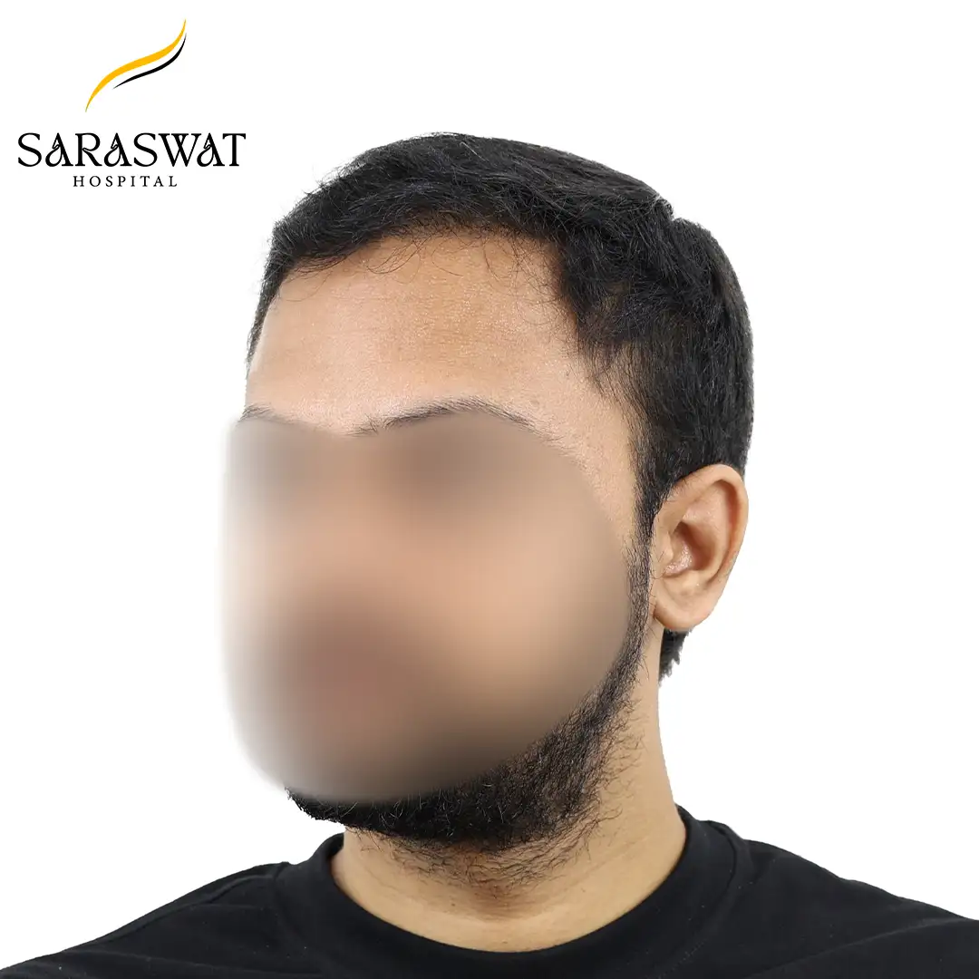 45 Degree Left FUE Hair Transplant Result After Procedure