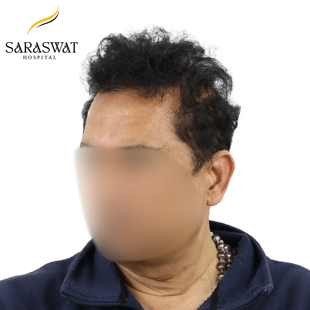 Hair Transplant Result