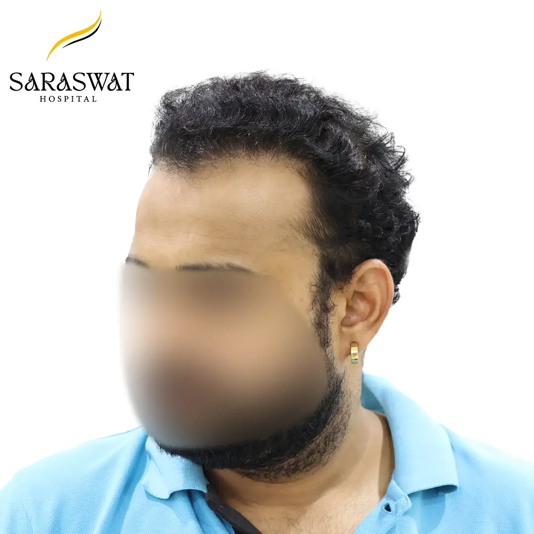 Hair Transplant Before After