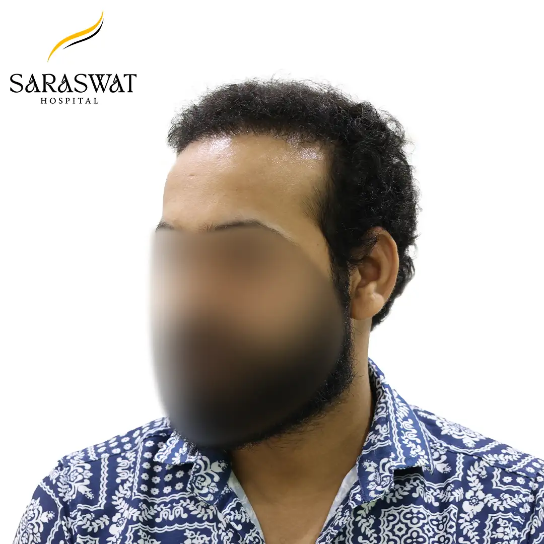 Hair Transplant Before After