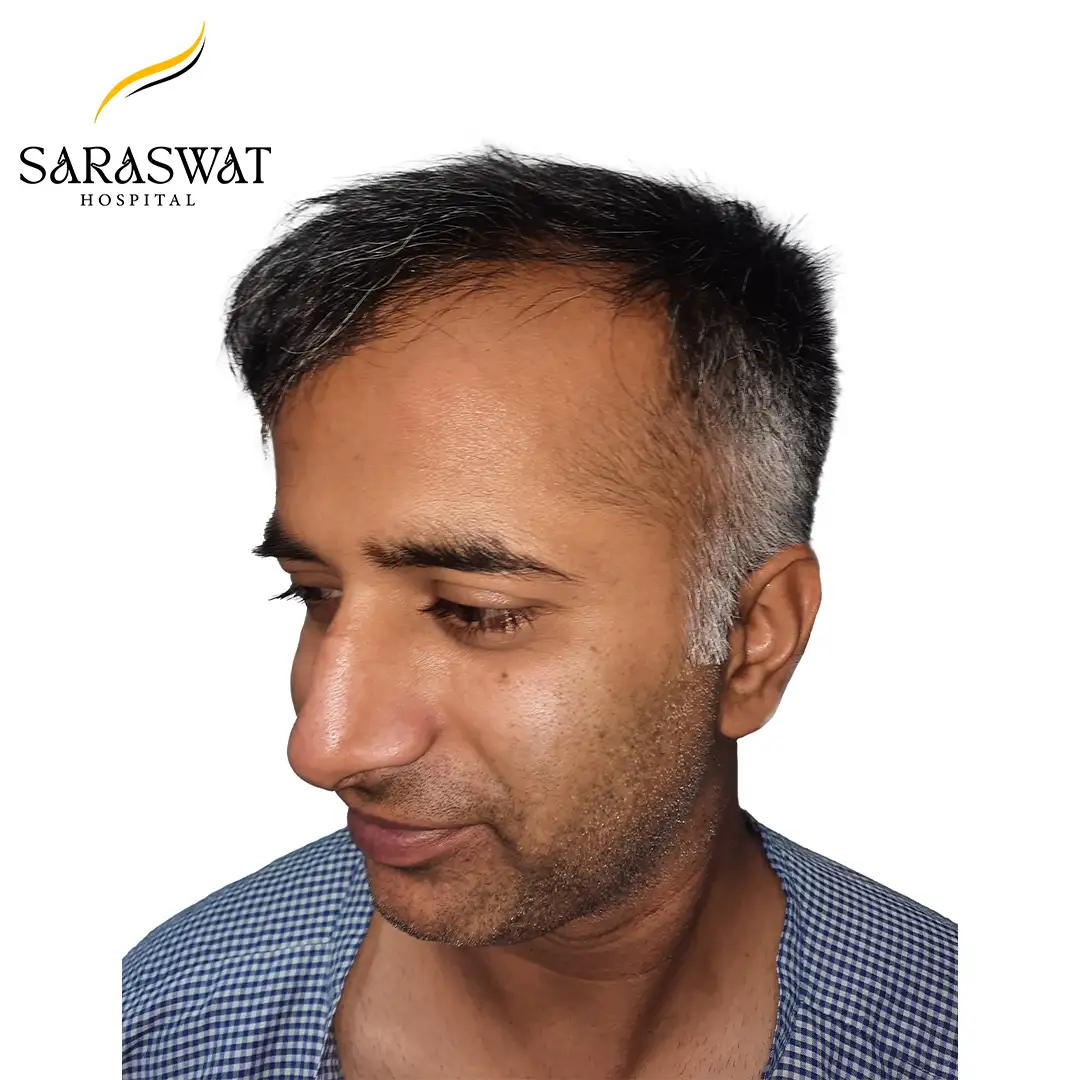 45 Degree Left FUE Hair Transplant Result Before Procedure